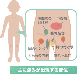 グロインペイン症候群で主に痛みが出る部位の図