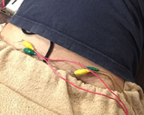 グロインペイン症候群に対する深層筋への鍼治療の様子